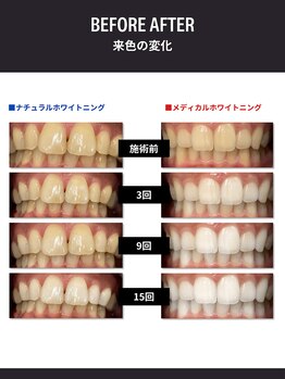 セルフダック 京都長岡京店/ホワイトニングの種類
