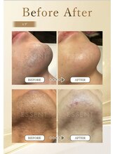 ロイズ(ROYCE)/頑固な髭にも効果あり