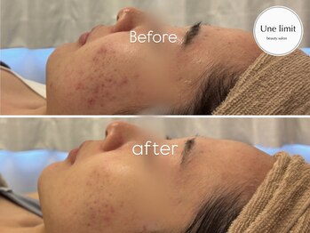 アンリミット 恵比寿店(Unelimit)/乳酸菌ピーリングBefore→after