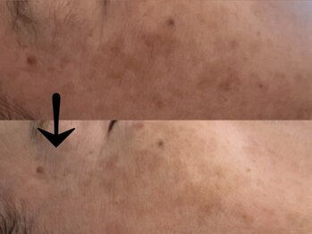 サロン ドロップ 上小田井(Salon drop)/「シミ改善」途中経過