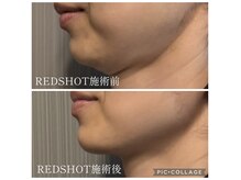 サイ(Sai)の雰囲気（【脂肪分解】たった1回！フェイスラインスッキリ！2cc使用）