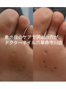 ズキーンと痛い魚の目