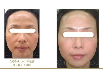 ベルメイク(BELLE MAKE)/ビフォーアフター