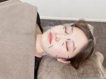 七里みんなの鍼灸整骨院/美容鍼は男女問わずおすすめ☆