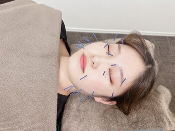 七里みんなの鍼灸整骨院/美容鍼は男女問わずおすすめ☆