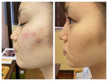 エイトオブワンズ/ニキビケア