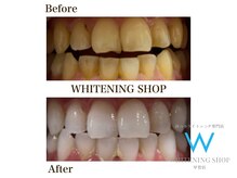 ホワイトニングショップ 甲賀店/Before&After『ホワイトニング』