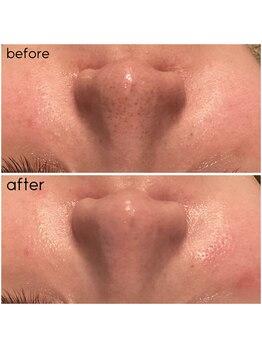 サロン リア(Salon Li’a)/毛穴の開き、ごわつきに☆