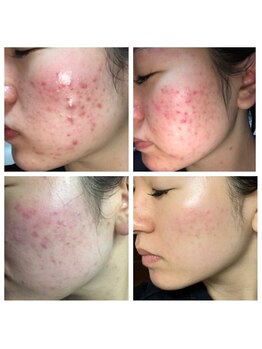 エステサロン 美飾り イオンモール木更津店/before⇒after/プラズマ