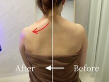 ミスティア(mistia)/エステ【首・肩】1回/After