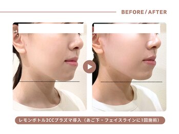 イエス マイサロン(yes My Salon)/レモンボトル施術例