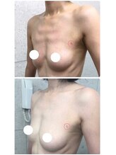 美人バスト 渋谷店/【バストアップ☆育乳】◇症例◇