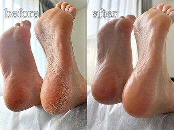 フットミー(foot mii)/施術1回での変化写真です