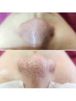 アナシアビューティーサロン(Anacia)/毛穴エクストラクション