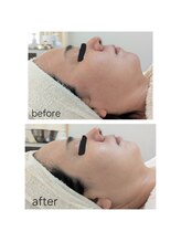 レゾン 京橋店/【ビフォーアフター】くすみ改善