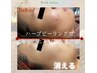 【口コミ割】肌質改善【顔】ハーブピーリング★1ｇ¥4800～