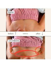 エミニナル(EMININAL)/【バストケア】ビフォーアフター