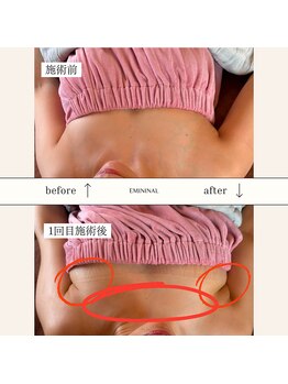 エミニナル(EMININAL)/【バストケア】ビフォーアフター