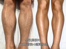 エクレ 柏店(EKURE)/メンズ脚脱毛