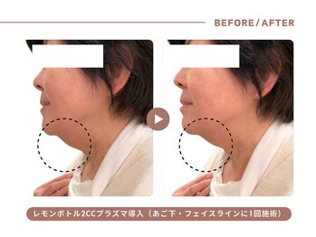 イエス マイサロン(yes My Salon)/レモンボトル施術例