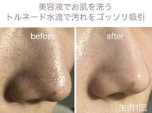 GRACETHOUSAND(グレイスサウザンド)/ハイドラ毛穴洗浄/毛穴吸引
