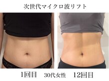 サロンドール(salon doll)の雰囲気(マイクロ波で深部の脂肪にアプローチ、くびれが復活しました♪)
