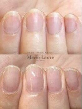 マリーロール 梅田店(Marie Laure)/自爪育成/深爪矯正/ネイルケア