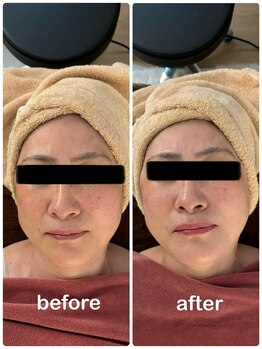 シュガー(Sugar...iyr)/【REVI】陶肌トリートメント初回