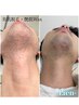 men's   ヒゲ脱毛　8,000→6600