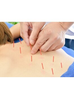 鍼灸施術を受けたい