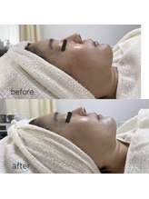 レゾン 京橋店/【ビフォーアフター】たるみ改善