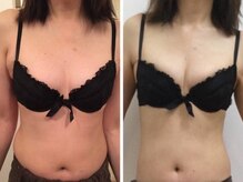 サンムーン(3moon)の雰囲気（左右差や綺麗なバスト形成もお任せ下さい♪[詳細はブログへ]）