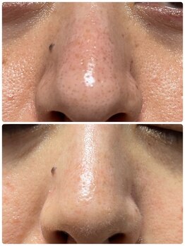 サロン ド ヤマト/毛穴黒ずみ (Before/After)