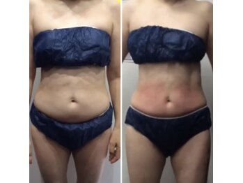 プリマプリート 各務原店/脂肪冷却2回！