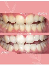 エクシアホワイトニング 札幌中島公園店/ホワイトニングビフォーアフター