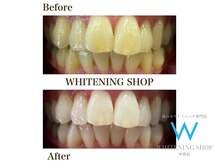 ホワイトニングショップ 甲賀店/Before&After『ホワイトニング』