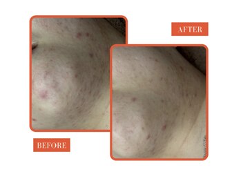 エナ(ENAK)/ララアクネでケア!