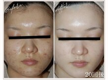 ミューベル(MYubelle)/ニキビケア美白　水光ピーリング