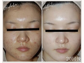 ミューベル(MYubelle)/ニキビケア美白 水光ピーリング