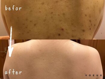 ボウ 名古屋店(VOEUX)/２０代　背中ニキビ　２５回