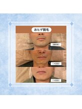 テトテ(tetote)/ヒゲ脱毛