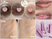 リリィ/ローマピンクで黒ずみケア