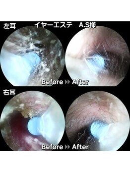 ツバキ 岐阜店(TSUBAKI)の写真/【岐阜希少】見て実感！イヤーエステで耳垢ケア＆耳つぼ♪極上ヘッドスパとのセットも◎/首肩こり/眼球疲労