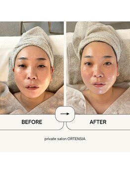 オルテンシア(ORTENSIA)/小顔矯正×美肌×毛穴洗浄