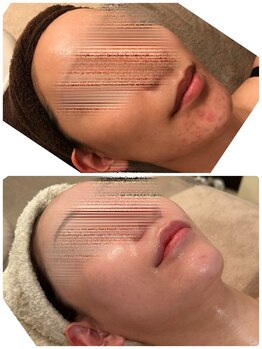 ヘアメイク エステサロン クラシカ(hairmake esthe salon clasika)/VOSサロンケア肌改善
