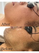 ミーエイト(Mii∞)/《ヒゲBefore/After》