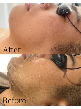 ミーエイト(Mii∞)/《ヒゲBefore/After》