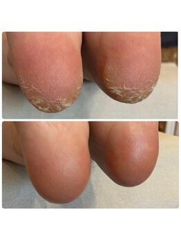 エメ(AIMer)の写真/角質除去・魚の目に悩んでいる方に◎足元つるん☆フットスペシャルケアコースがおすすめ♪つるすべ足裏に！