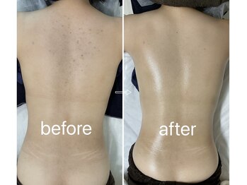 月とルーツ 大阪南堀江(月とroots)/背中ニキビ・跡・毛穴・黒ずみ