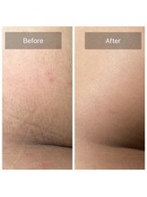 ビビ(VIVI)/お尻のざらつきに